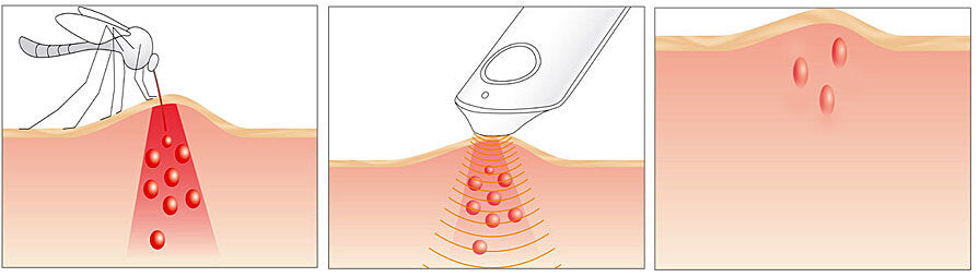Drei Bilder: Insekt auf Haut, Ultraschallgerät über Haut, Haut mit drei Einstichen.