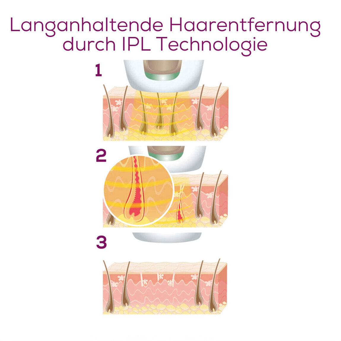 Illustration der langanhaltenden Haarentfernung durch IPL-Technologie in drei Schritten.