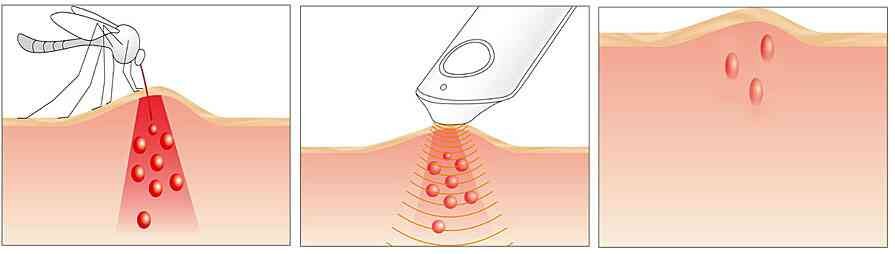 Illustration von Aknebehandlung: Pickel werden mit einem Werkzeug, Laser oder Licht behandelt.