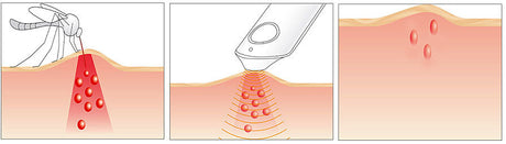 Drei Bilder: Insekt auf Haut, Ultraschallgerät über Haut, Haut mit drei Einstichen.