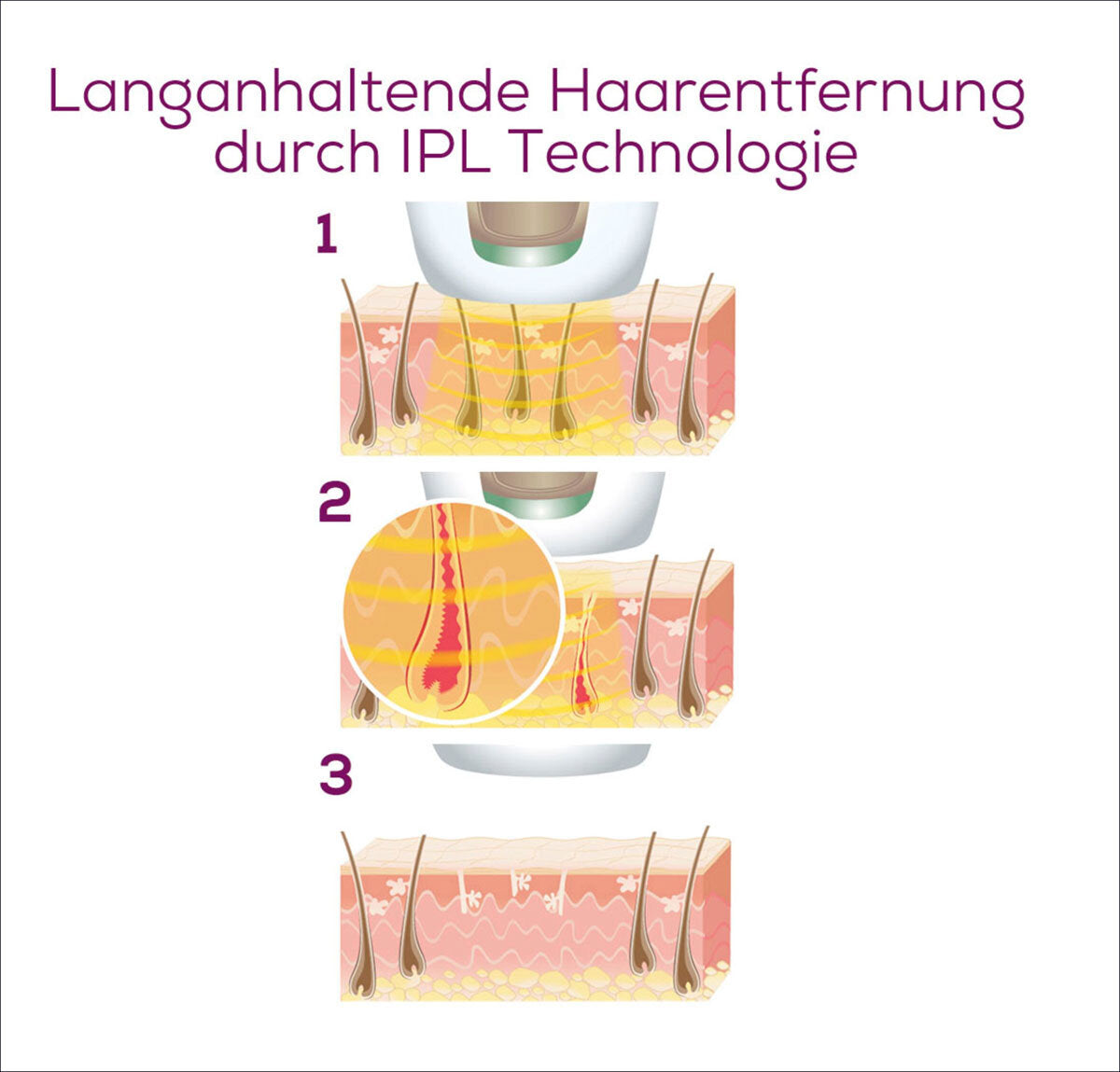 Illustration der langanhaltenden Haarentfernung durch IPL-Technologie, mit drei Schritten: Behandlung, Haarwurzelausschaltung